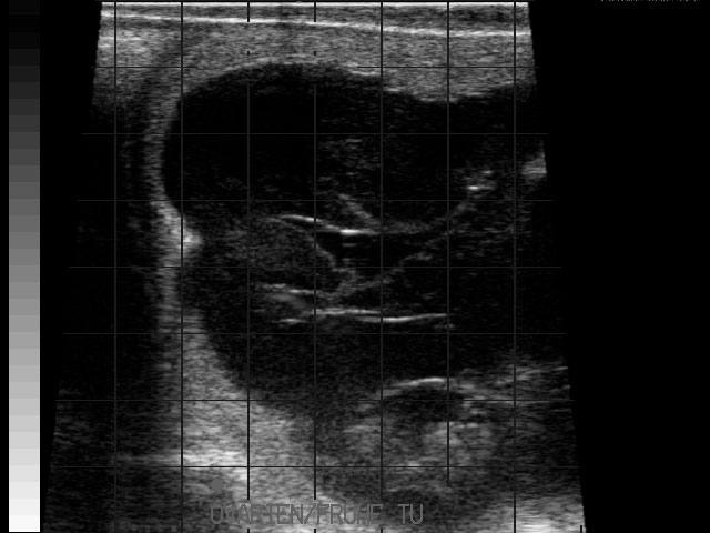 Ultraschallbild &ndash; Resorption Zwillinge