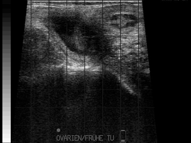 Ultraschallbild &ndash; Resorptionlebender Zwilling